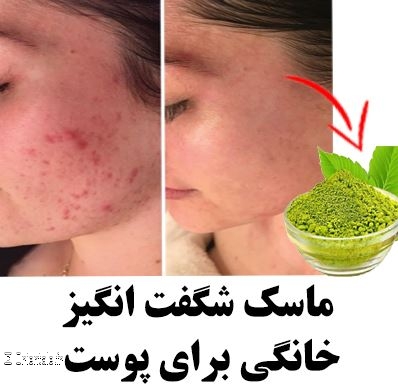Le henné guérirait l'acné selon les Iraniennes